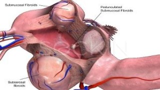 da Vinci Hysterectomy Surgery by Dr R K Mishra