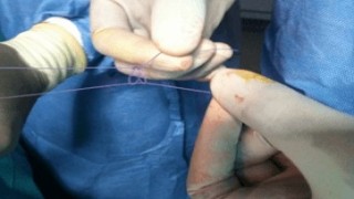 Exploring the Advantages: Discover Why Laparoscopic Surgery is the Preferred Choice for Many