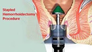 Understanding the Rudimentary Uterus: Causes, Symptoms, and Treatment Options