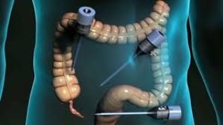 Unedited Laparoscopic Hysterectomy: A Live Surgical Demonstration by Dr. R. K. Mishra