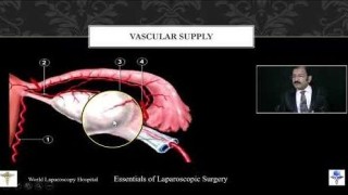 Laparoscopic Precision Unveiled: Ovarian Teratoma Removal with Minimally Invasive Expertise