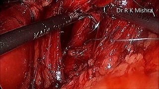 Laparoscopic Myomectomy: A minimally invasive approach to remove uterine fibroids