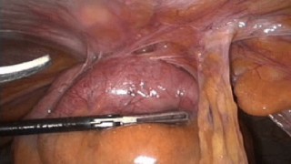 Laparoscopic sleeve gastrectomy with endoscopic calibration