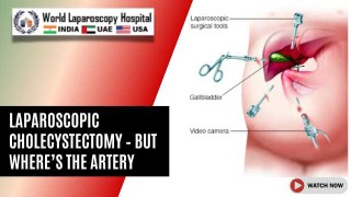 Laparoscopic Cholecystectomy Mystery: Locating the Hidden Cystic Artery with Precision and Safety
