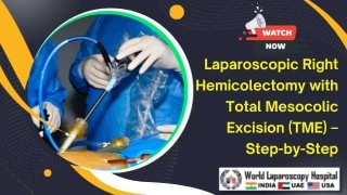 Step-by-Step Laparoscopic Right Hemicolectomy with Total Mesocolic Excision (TME)