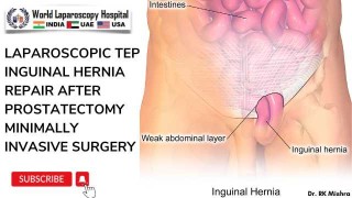 Laparoscopic TEP Inguinal Hernia Repair After Prostatectomy: A Minimally Invasive Surgical Approach