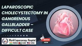 Difficult Laparoscopic Cholecystectomy in Gangrenous Gallbladder: Short Surgical Video