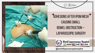 Retrocecal Appendicitis: A Challenging Laparoscopic Appendectomy