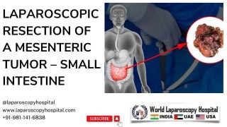 Optimal Bowel Preparation for a Smooth Laparoscopic Surgery