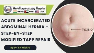 Modified TAPP Technique for Acute Incarcerated Hernia