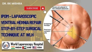 Laparoscopic IPOM for Ventral Hernia: Step-by-Step Repair Guide