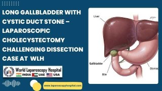 Laparoscopic Cholecystectomy in 10 Minutes – Performed by Dr. R. K. Mishra
