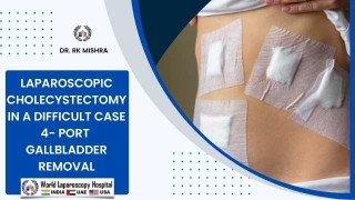 Difficult Gallbladder: 4-Port Laparoscopic Cholecystectomy Technique