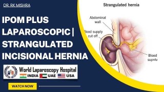 Ovarian Drilling by Laparoscopy for PCOS
