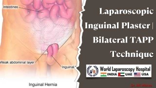 Bilateral TAPP Inguinal Hernia Repair: Innovative Laparoscopic Inguinal Plaster Technique