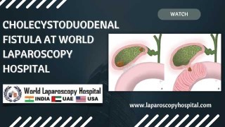 Reinforced Recovery: Laparoscopic IPOM Plus Technique for Ventral Hernia Reconstruction