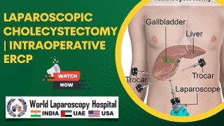 Obesity Surgery Sleeve Gastrectomy Lecture by Dr R K Mishra