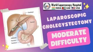 Laparoscopic Inguinal Hernia Repair: A Minimally Invasive Approach for Females