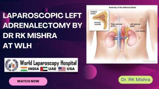 Essential Laparoscopic Cholecystectomy: Step-by-Step Safe Gallbladder Removal