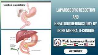 Laparoscopic Resection with Hepatoduojenostomy Reconstruction