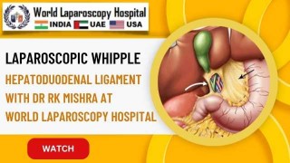 Mastering the Hepatoduodenal Ligament: Specialized Laparoscopic Whipple Technique