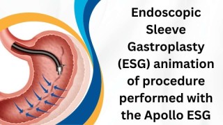 Laparoscopic Myomectomy for Posterior Wall Myoma