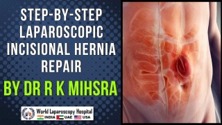Complete Laparoscopic Incisional Hernia Repair | World Laparoscopy Hospital