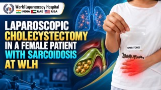 Laparoscopic Cholecystectomy in a Female Patient with Sarcoidosis | Dr. R.K. Mishra