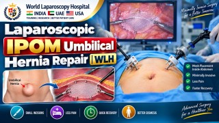 Laparoscopic IPOM Umbilical Hernia Repair in Just 8 Minutes | Surgical Video | WLH